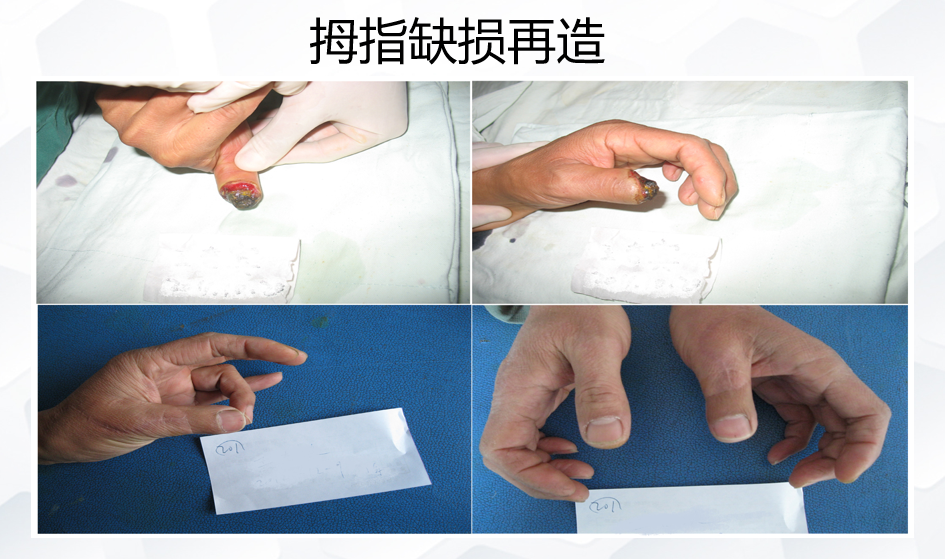 拇指缺损再造.png