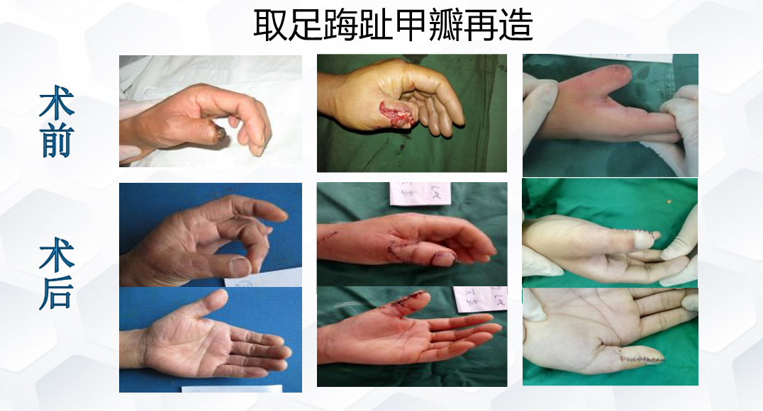 取足踇趾甲瓣再造.png