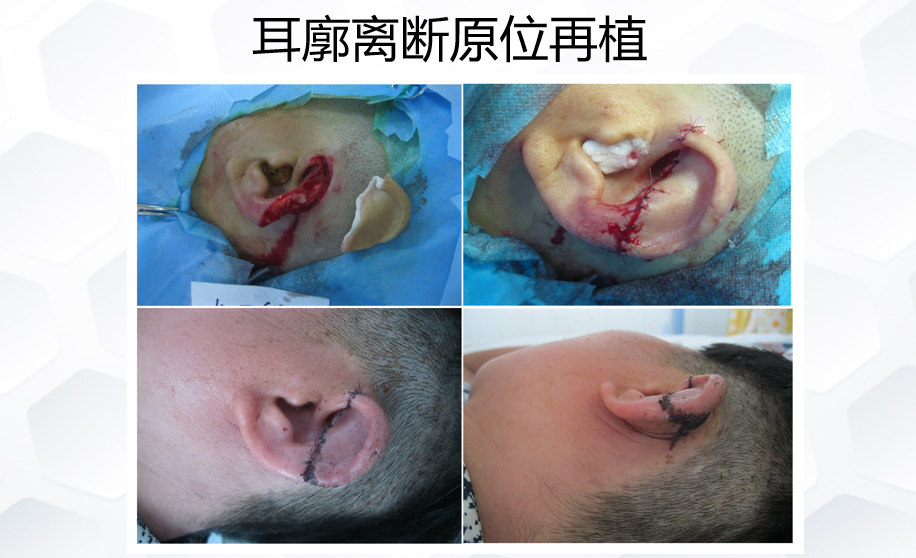 耳廓离断再植.png