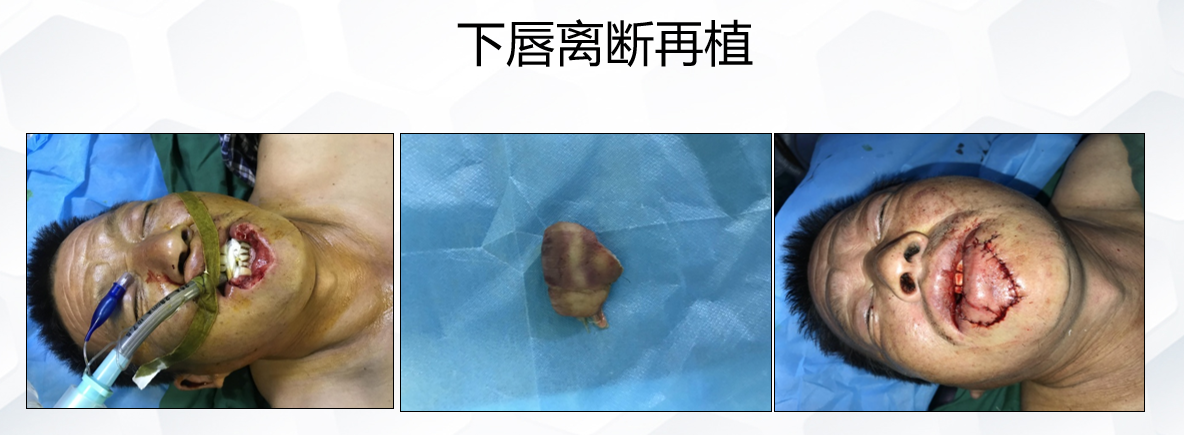 下唇离断再植.png