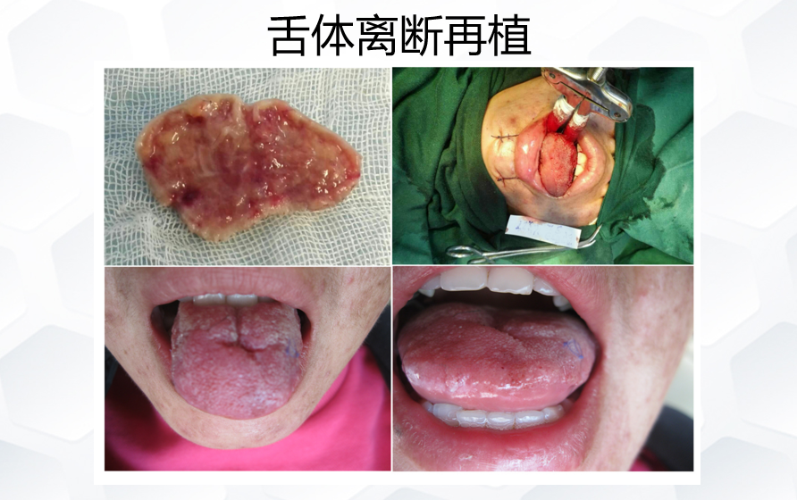 舌体离断再植.png