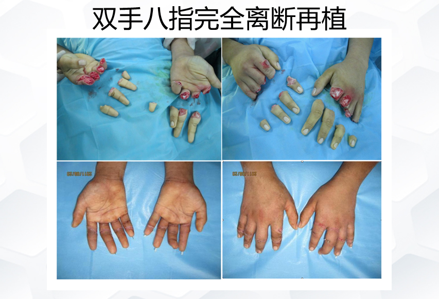 双手八指离断.png