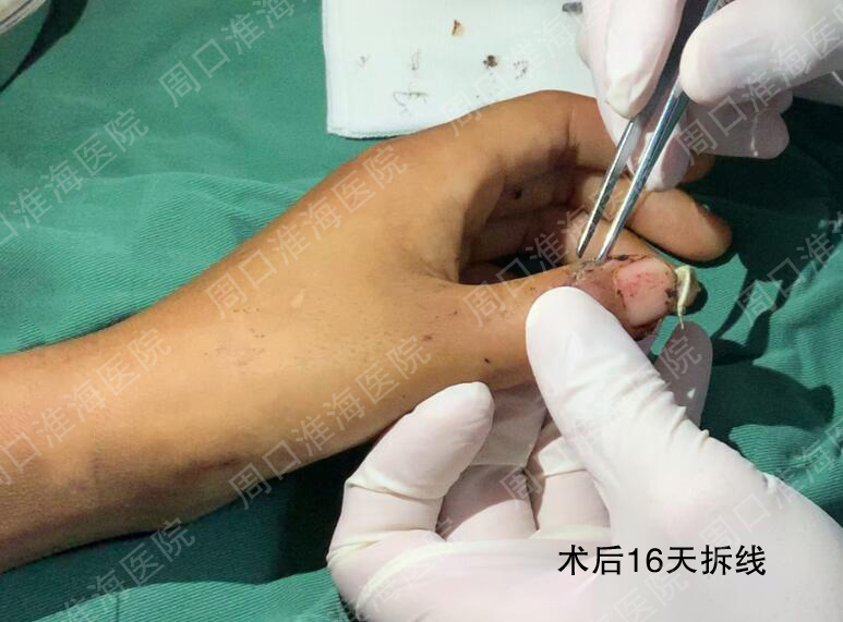 术后16天拆线（手指正面）.jpg