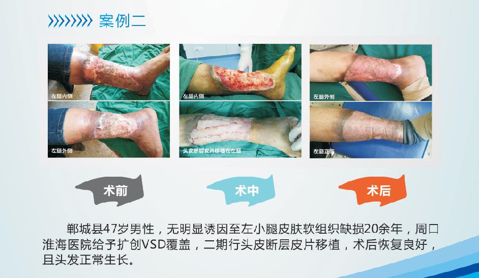 难愈性创面2.jpg