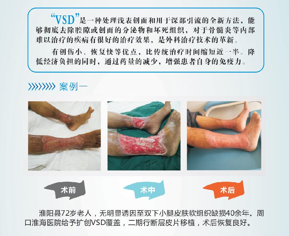 难愈性创面1.jpg